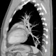 Anomalous blood supply from systemic circulation in left lower lung lobe: CT - Computed tomography